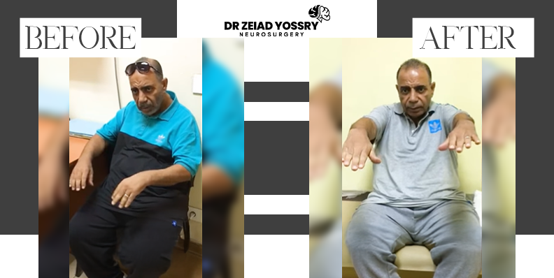 نجاح-عملية-تحفيز-الدماغ-العميق-واستعادة-المريض-حياته-الطبيعية
